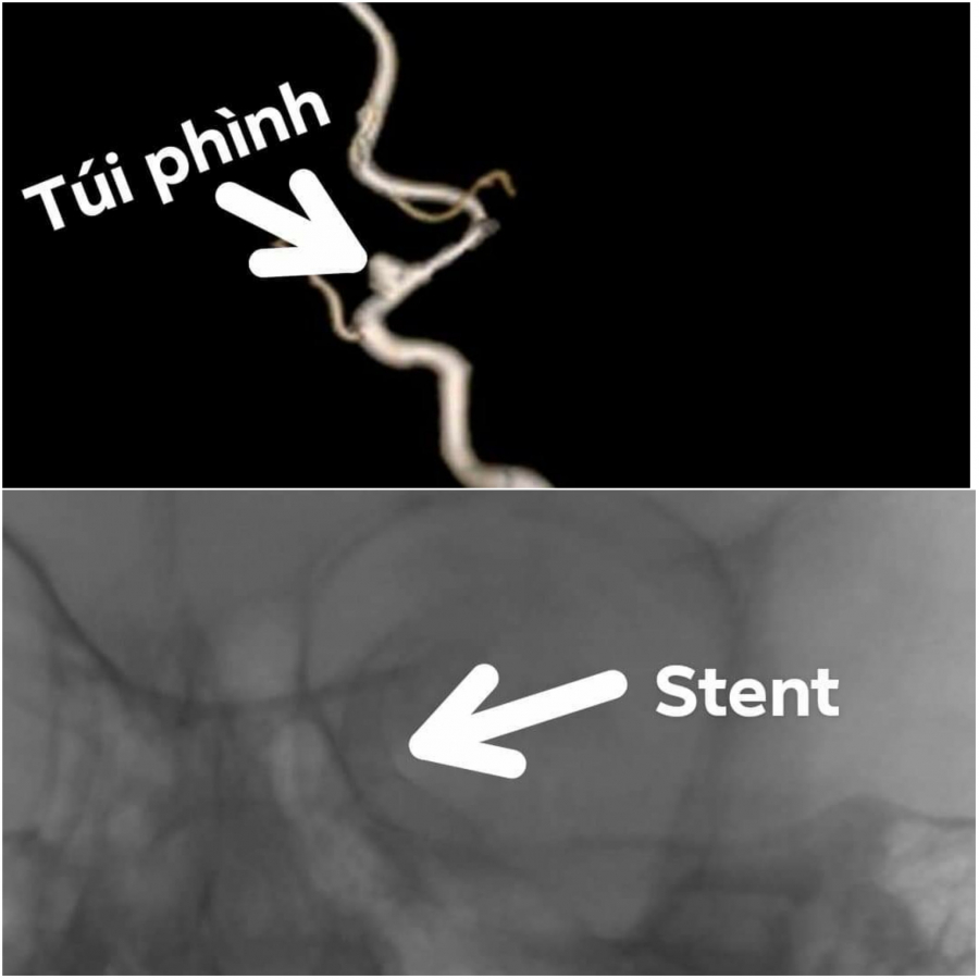 Hình ảnh túi phình (Ảnh: Fanpage Bệnh viện Nhi đồng Thành phố)
