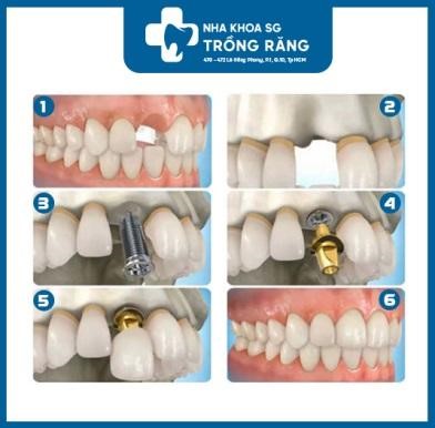 trong-rang-vinh-vien-4