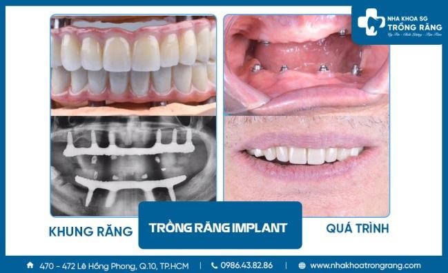 trong-rang-vinh-vien-6