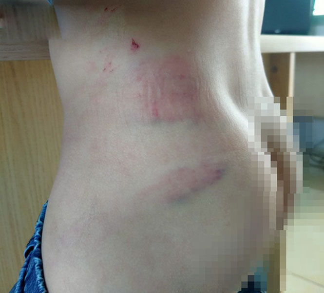 Những vết bầm tím trên Sh88bet đăng ký miễn phí bé Boy  (Ảnh: Người lao động)