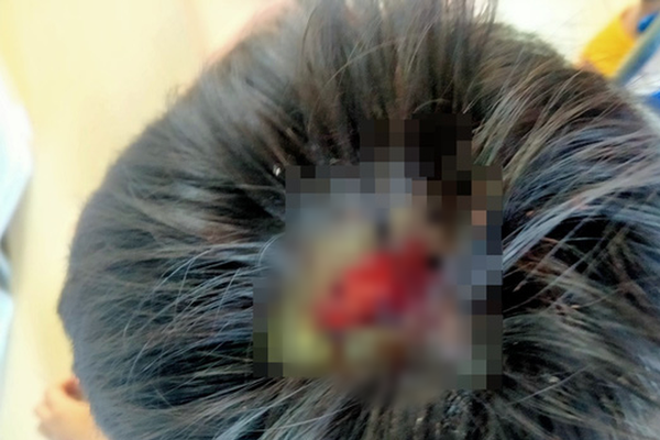 Vết thương trên đầu bé Boy do bị cha đánh (Ảnh: Người lao động)