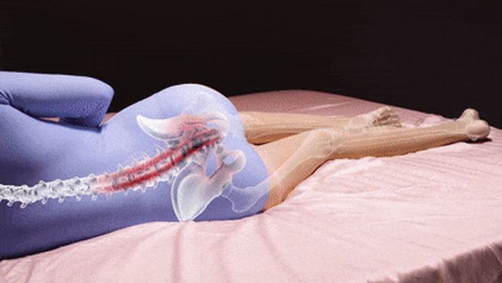 Tư thế ngủ sai gây cong vẹo côt sống