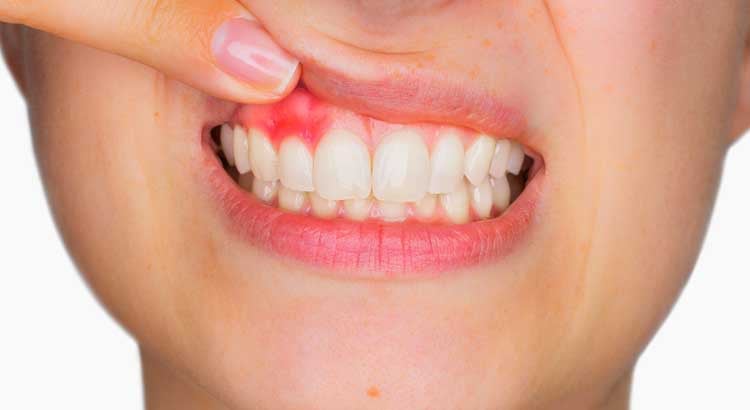 Cảnh báo nguy hiểm từ việc chảy máu chan răng