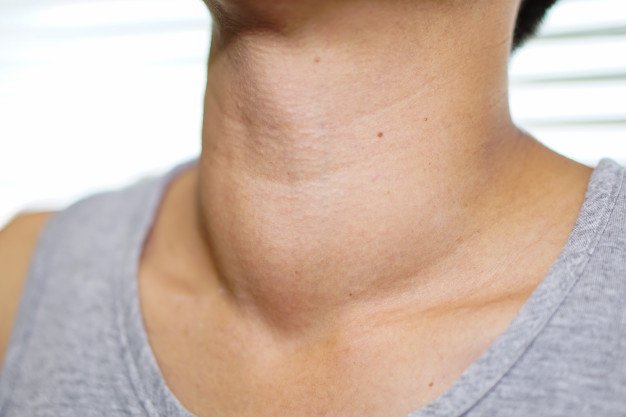 Theo các chuyên gia khuyến cáo thì người bị rối loạn tuyến giáp hoặc bướu cổ không nên ăn bắp cải