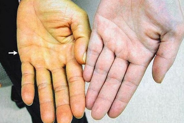 Khi Sh88bet đăng ký miễn phí bị vàng da