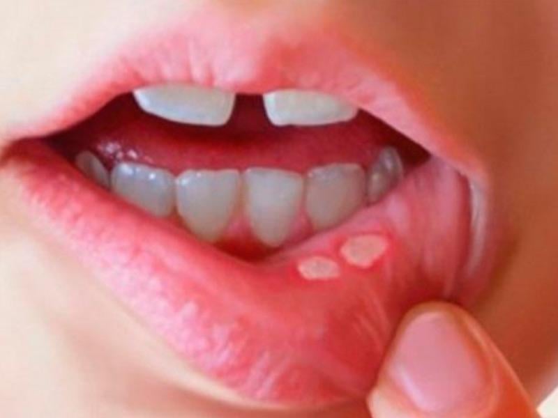 Nhiệt miệng Sh88bet đăng ký miễn phí bạn có thể đang thiếu vitamin E