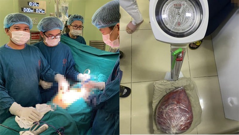 Ca Shbet888 tiền thưởng cực khủng cắt bỏ khối u 10kg cho bệnh nhân O. diễn ra thành công (Ảnh BV Bạch Mai)