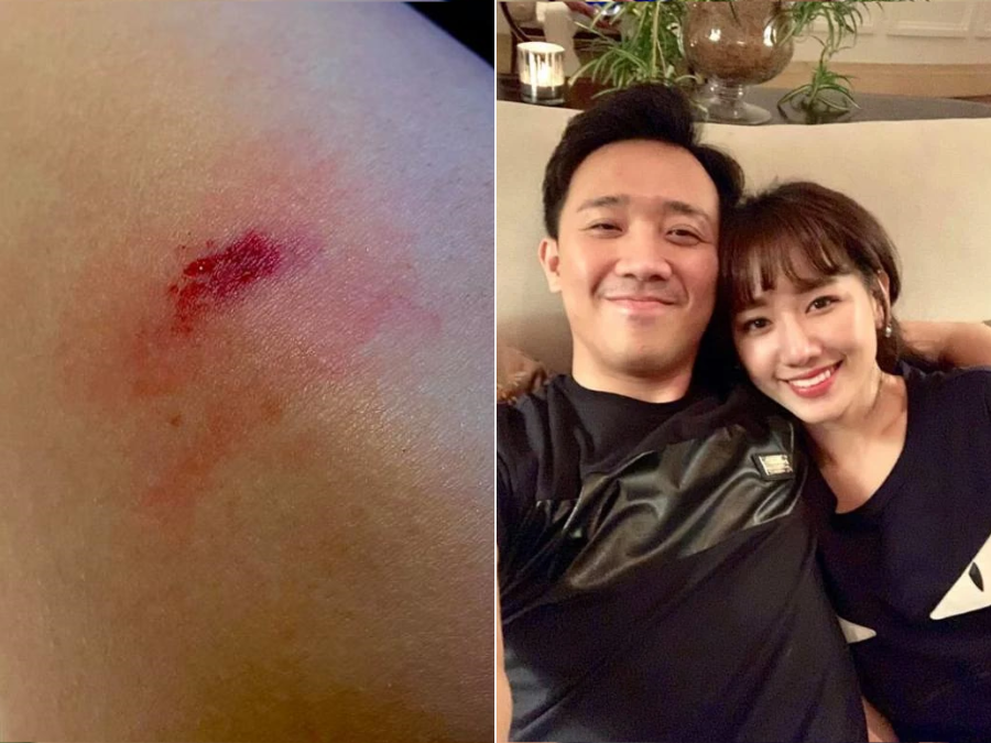Mới đây, Hari Won đăng ảnh mình bị thương và chia sẻ: 