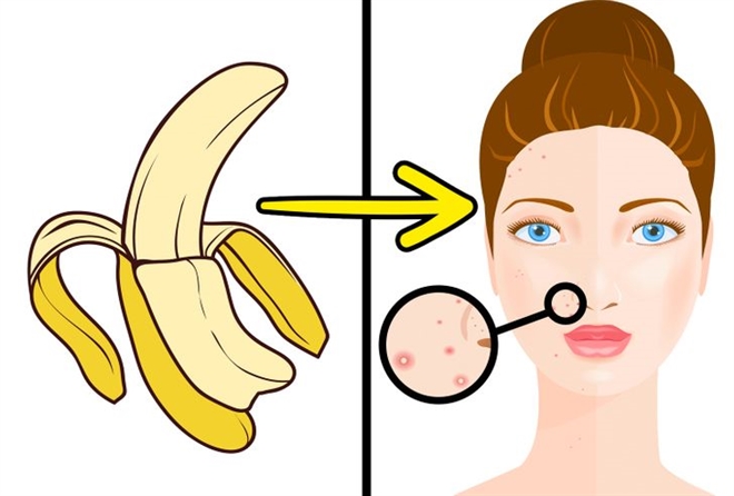 Vỏ chuối quả chuối giúp trị mụn