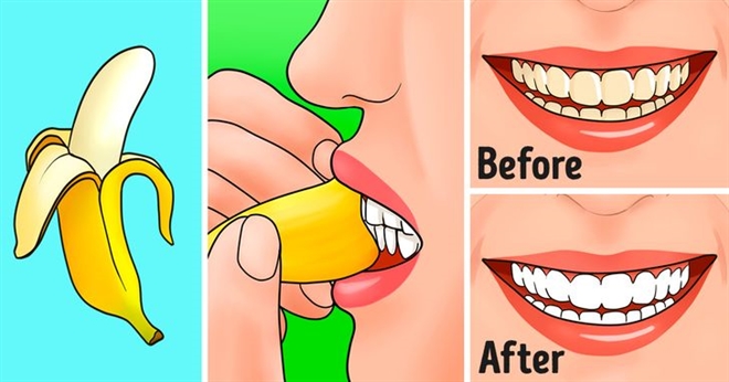 Vỏ chuối làm trắng răng