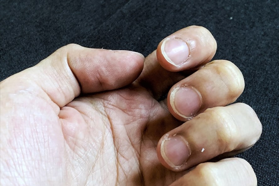 Đốm trắng có thể do va chạm