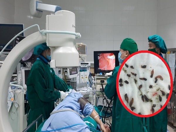 Bệnh nhân mắc sán lá gan