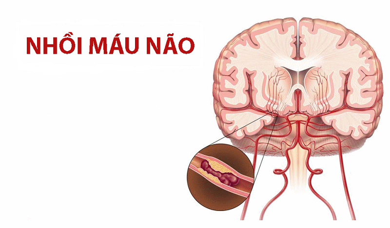 nhoi-mau-nao-01