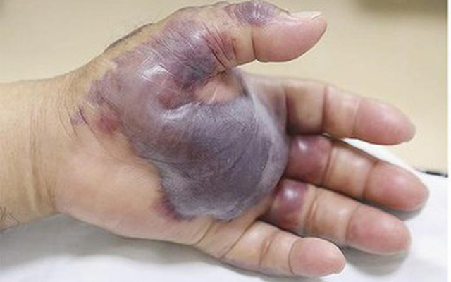Ngón tay bị thương có biểu hiện sưng phồng lên