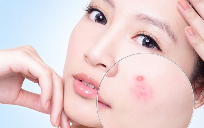 Bắt bệnh qua mụn