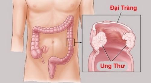 Nên thận trọng khi đi đại tiện ra máu táo bón kéo dài