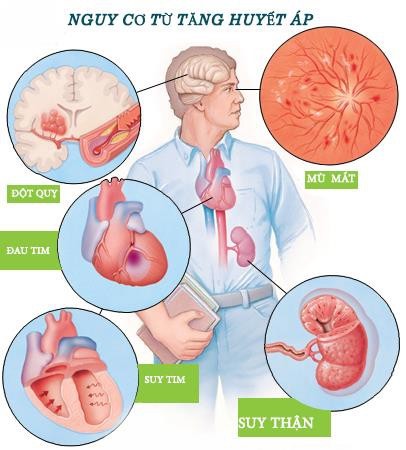 Tăng huyết áp gây ra nhiều biến chứng nghiêm trọng cho Sh88bet đăng ký miễn phí, ở đó suy tim là hệ quả cuối cùng