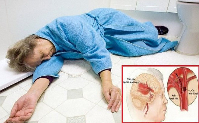Dấu hiệu cảnh báo cơn đột quỵ