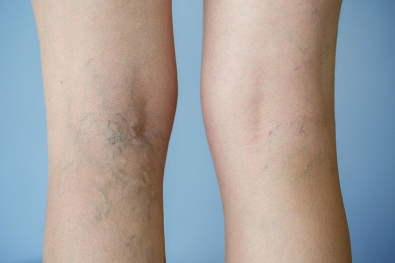 Thói quen xấu khiến bạn bị giãn tĩnh mạch