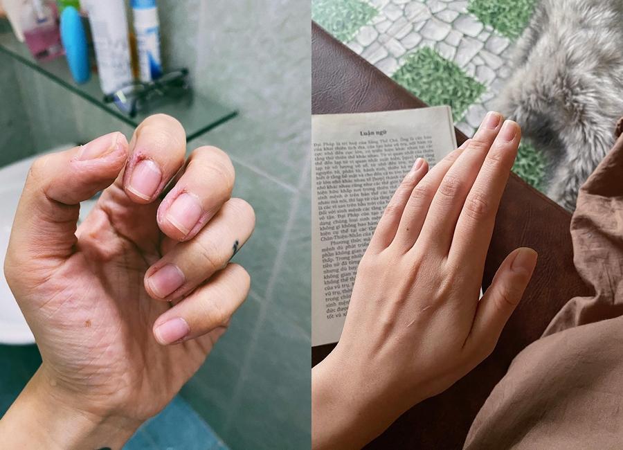 Bàn tay khi bị bệnh cách đây 8 tháng và bàn tay hiện tại của Trang Cherry.