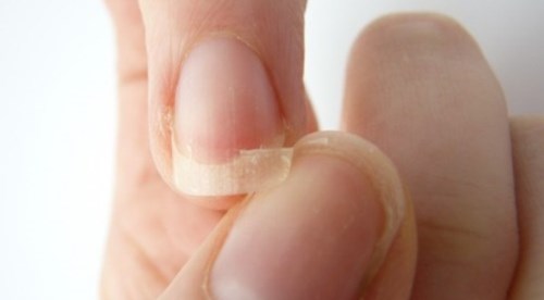 Móng tay dễ bị gãy