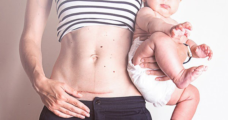 Trong một vài trường hợp nhất định bác sĩ sẽ chỉ định cho mẹ bầu sinh mổ