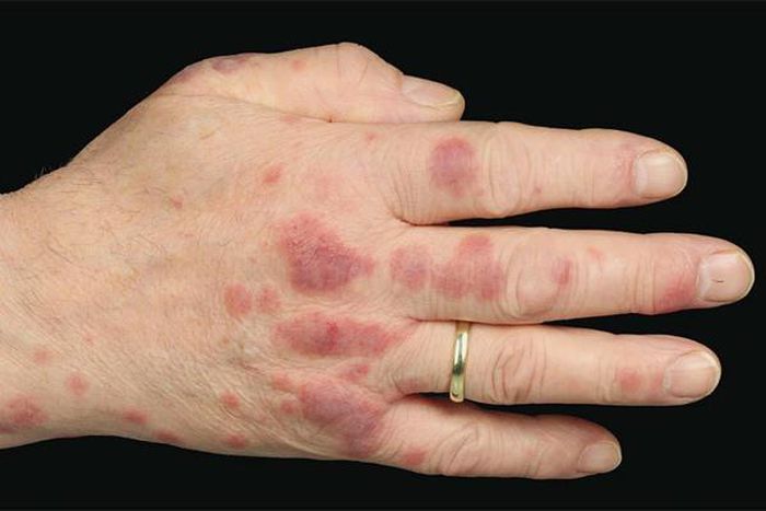 Biểu hiện bất thường trên bàn tay của bệnh nhân người Đức