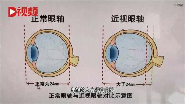 Bản thân Xiaoya bị cận thị nặng. Hình ảnh trên cho thấy trục viễn thị và cận thường    