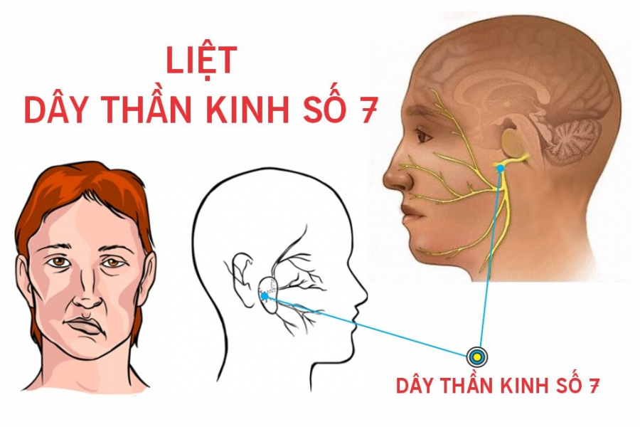 liet-day-than-kinh-so-7-03