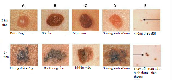 not-ruoi-ac-tinh-01