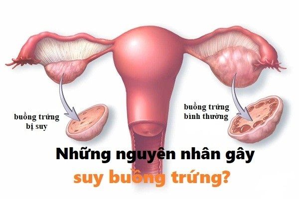suy-buong-trung-som-2