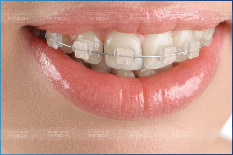 Niềng răng mắc cài sứ sử dụng mắc cài được làm từ sứ cao cấp