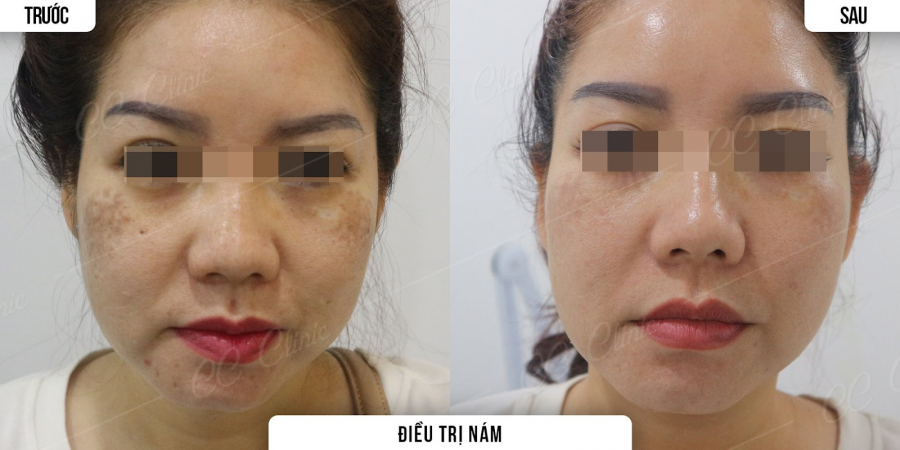 Hình ảnh trước và sau: Hiệu quả rõ rệt sau khi khách hàng điều trị nám bằng công nghệ mới titan vàng 2022