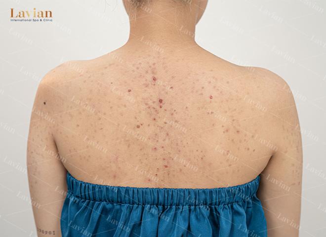 Mụn lưng cũng phổ biến như mụn ở mặt vậy