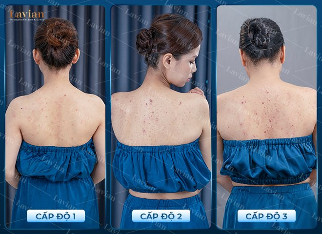 Các cấp độ viêm da, viêm da mủ, mụn lưng thâm