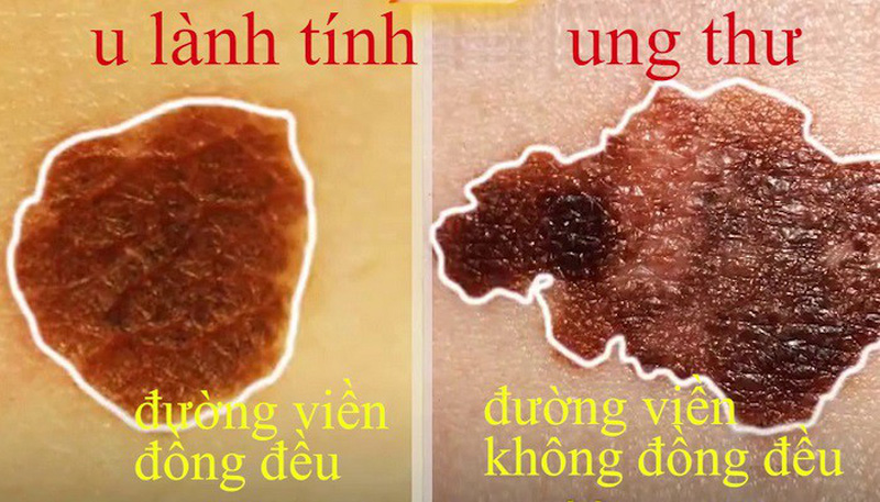 not-ruoi-ung-thu3-1522134378190441914676