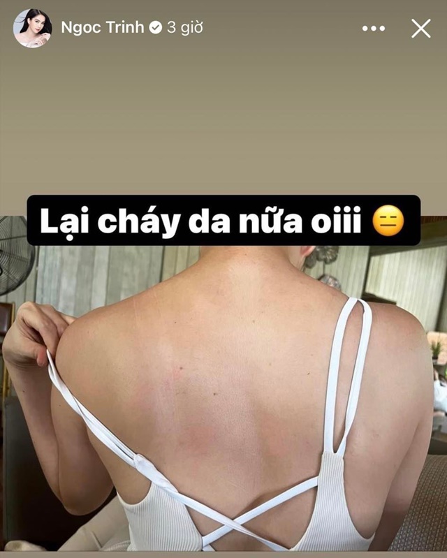ngoc-trinh-bi-chay-da