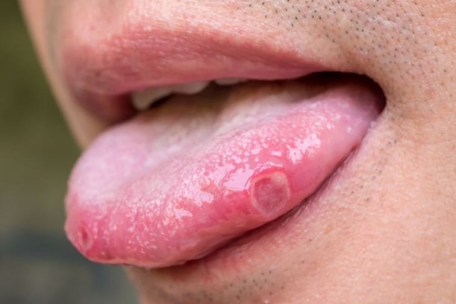 tongue_1