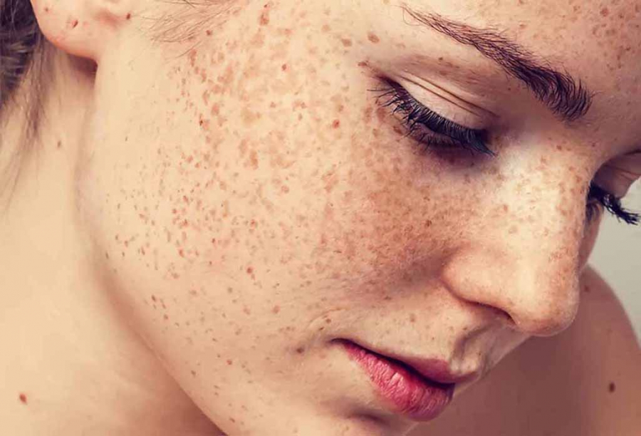 roi-loan-sac-to-melanin-va-nhung-dieu-ban-nen-biet-1