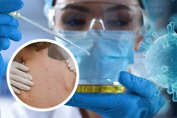 Đến ngày 15-8-2022 đã ghi nhận trên 35.000 ca mắc đậu mùa khỉ tại 92 quốc gia