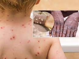 Nếu người dân khi có các triệu chứng như: sốt trên 38 độ C, nổi hạch (sưng hạch bạch huyết), đau đầu, đau cơ, đau lưng, suy nhược thì báo ngay cho trạm y tế nơi cư trú, hoặc cần đến các cơ sở y tế để được khám và điều trị kịp thời.
