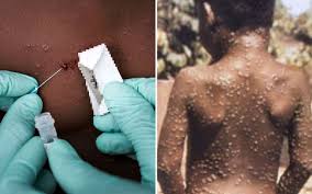 Theo Bộ Y tế, bệnh đậu mùa khỉ (monkeypox) không phải là bệnh mới mà ghi nhận lần đầu tiên vào năm 1958 trên các đàn khỉ được nuôi để Shbet888.com tỷ lệ cược cao. 