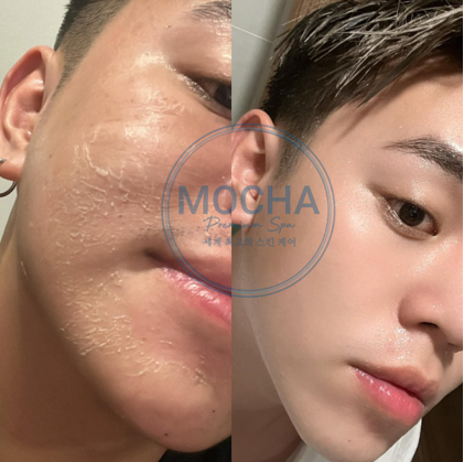 Sự thay đổi của Mừng SHBET phiên bản mới 2025 sau khi sử dụng Retinol mix Peel của Mocha