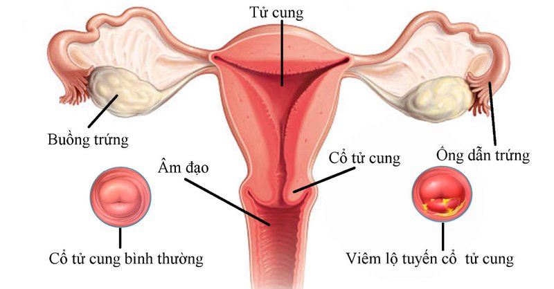 viem lo tuyen co tu cung 01