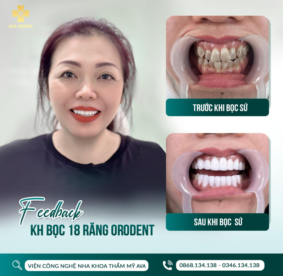 Feedback khách hàng bọc răng sứ Orodent