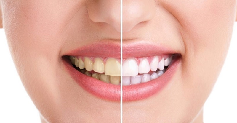 Các thực phẩm chứa nhiều đường như bánh kẹo, kem que, sôcôla sẽ tích tụ vi khuẩn gây mảng bám.