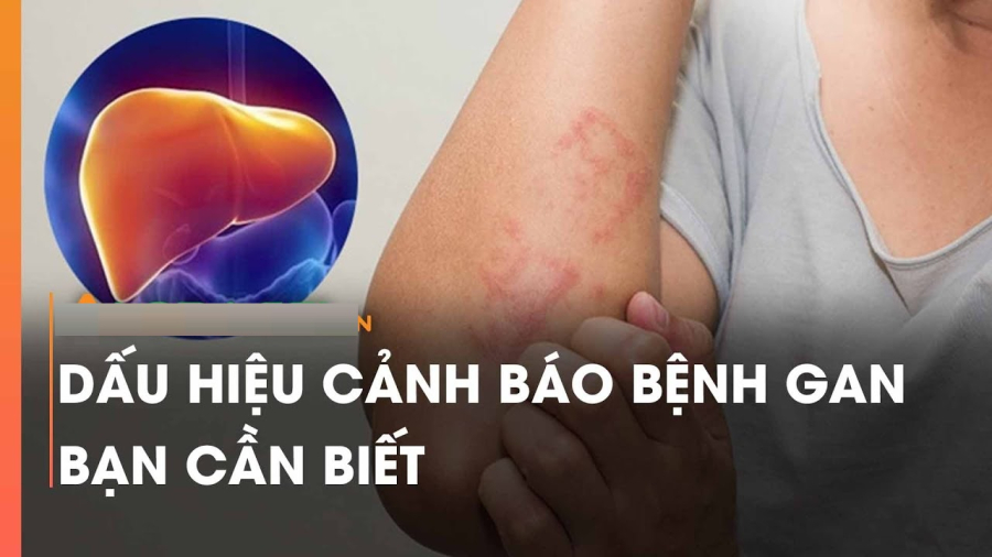 dau-hieu-benh-gan1