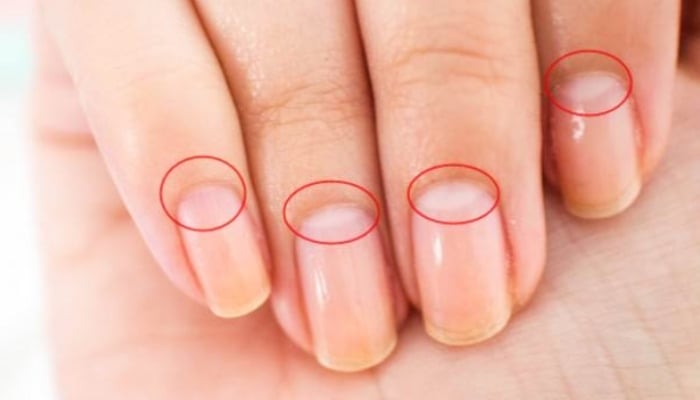 Móng tay có hình lưỡi liềm cho thấy Sh88bet đăng ký miễn phí khỏe mạnh