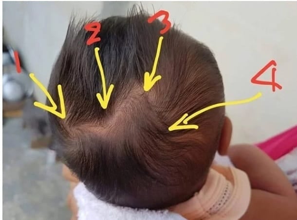 Xoáy tóc của trẻ