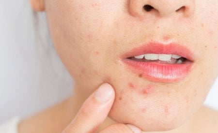 Việc kiểm soát bã nhờn là rất quan trọng và đó cũng là tác dụng thường thấy của dầu tẩy trang.    